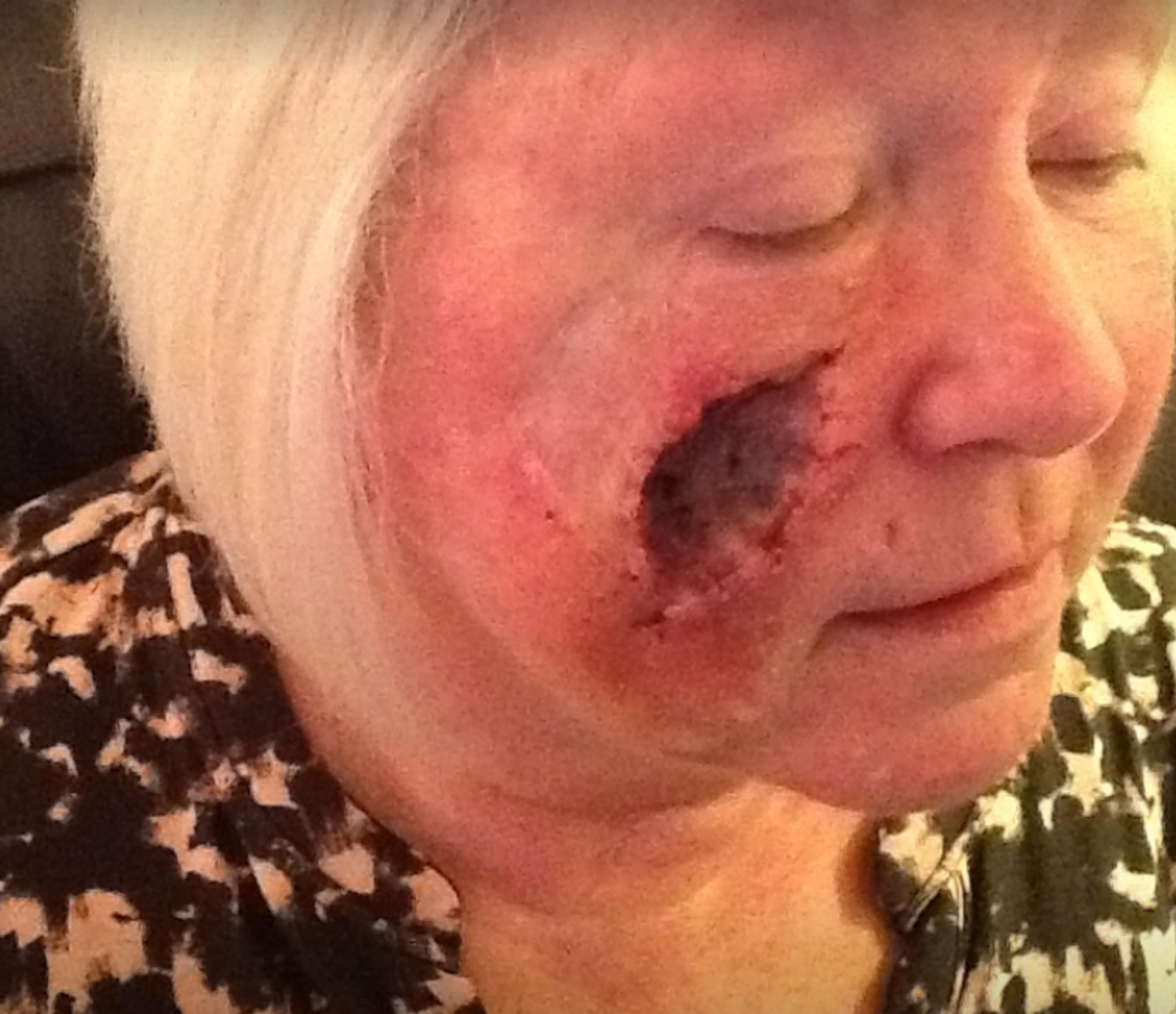 &#13;
This horrific image shows the effects of the multiple operations on Elaine's face (Mercury Press and Media)&#13;