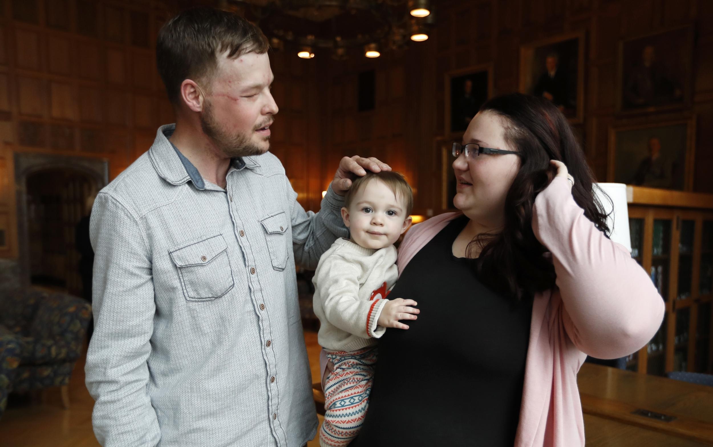 The face transplant operation took 56 hours and involved more than 60 medical professionals