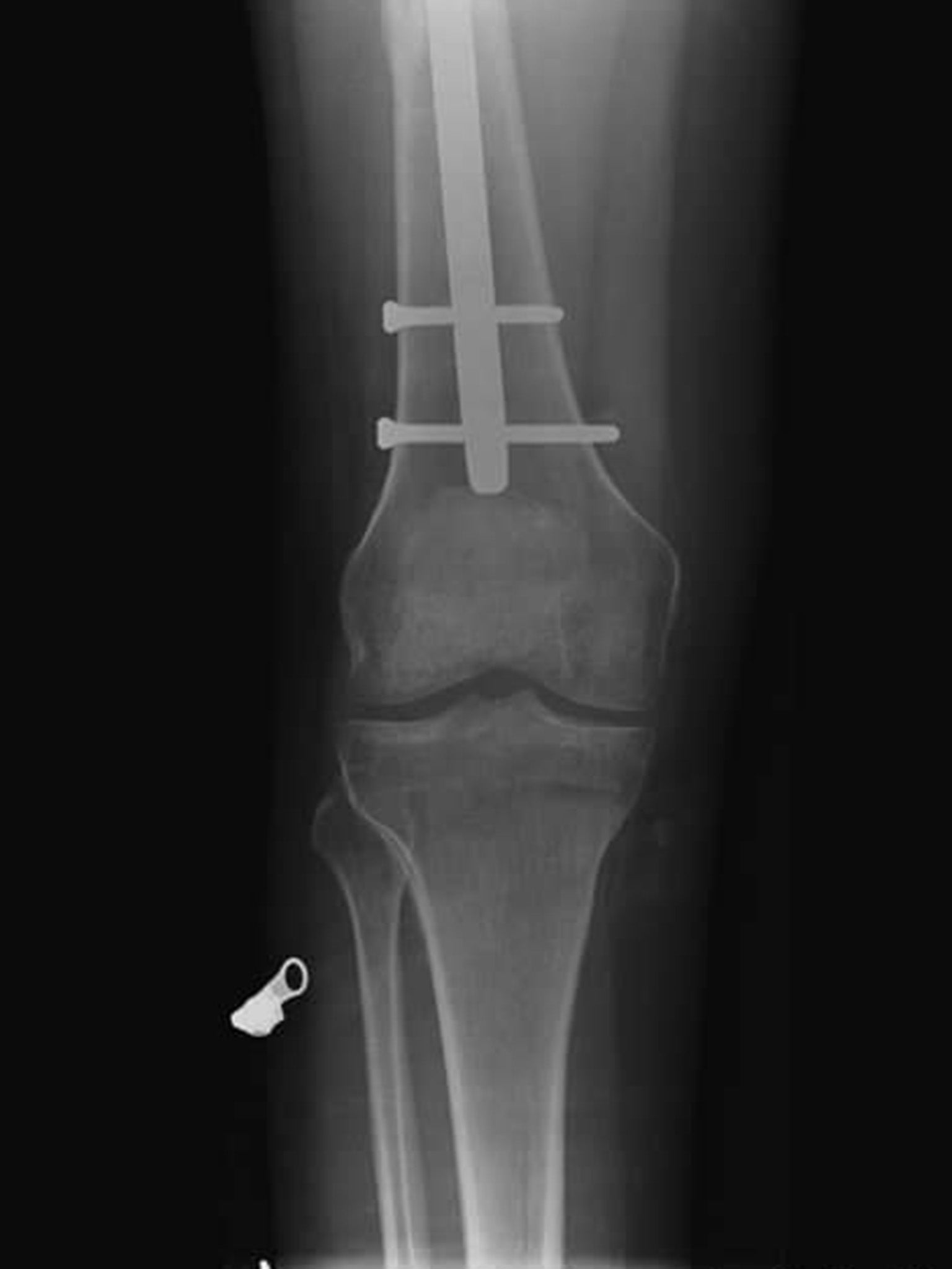 An X-ray showing the shattered bone of Carlo De Chiro