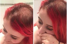 Blogger with cervical cancer shares candid photos of hair loss on Inst