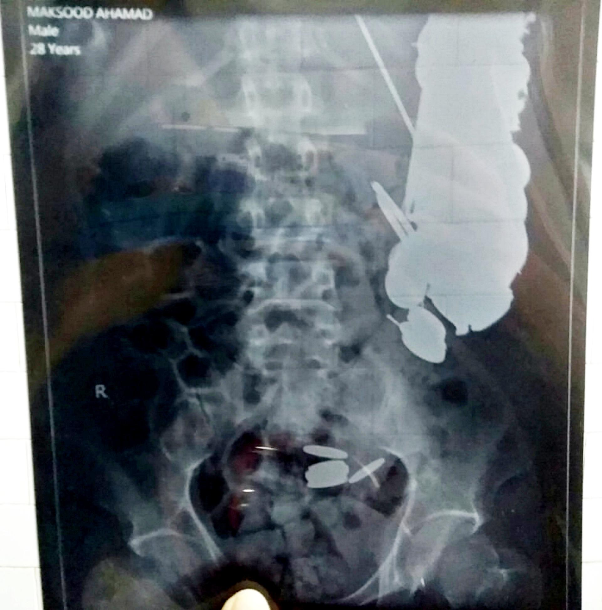 Khan had swallowed various sharp items SWNS.com