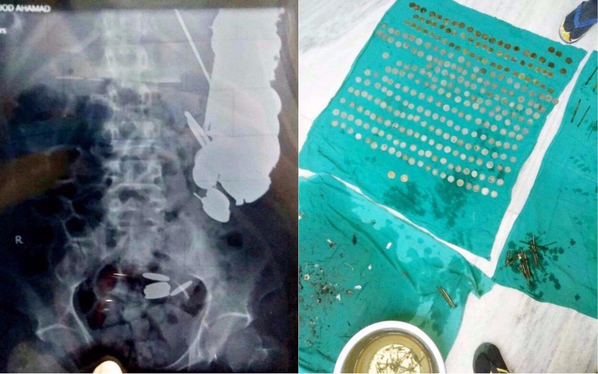 Surgeons operating on man for stomach bug shocked to find hundreds of