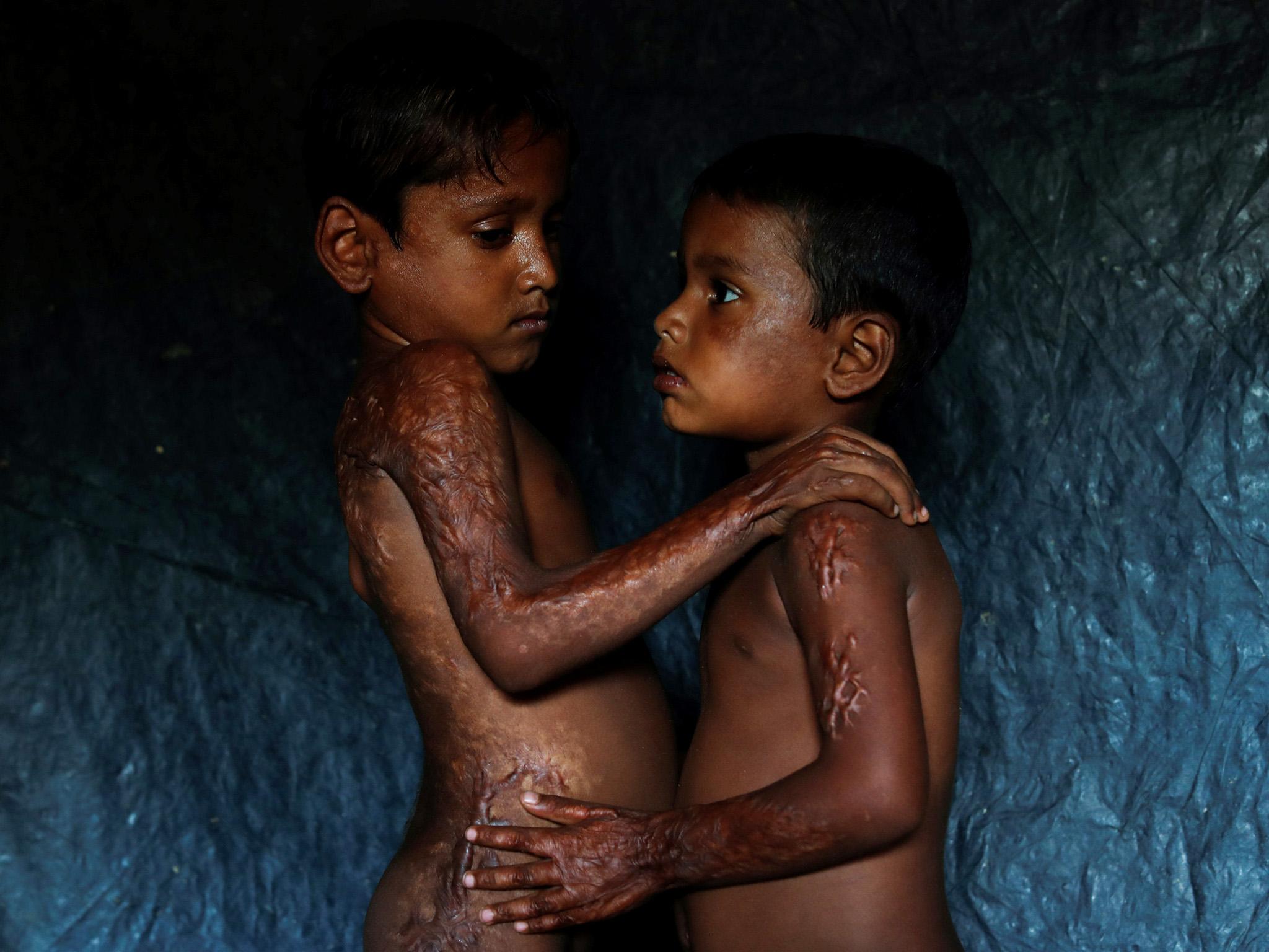 Rohingya refugees Mohamed Heron, 6, and his brother Mohamed Akter, 4, show the burns they suffered after Myanmar's armed forces fired rockets at their village