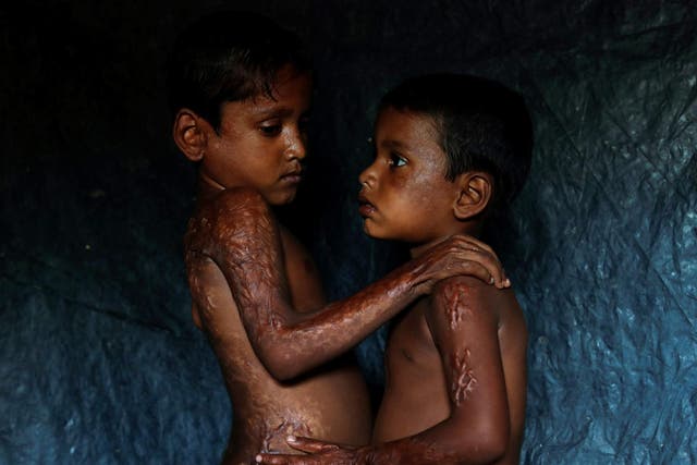 Rohingya refugees Mohamed Heron, 6, and his brother Mohamed Akter, 4, show the burns they suffered after Myanmar's armed forces fired rockets at their village