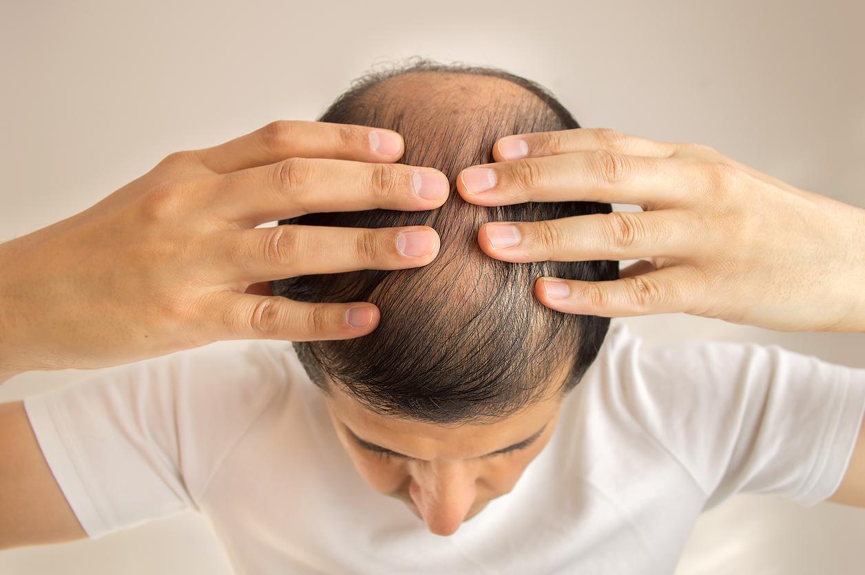 male pattern baldness young