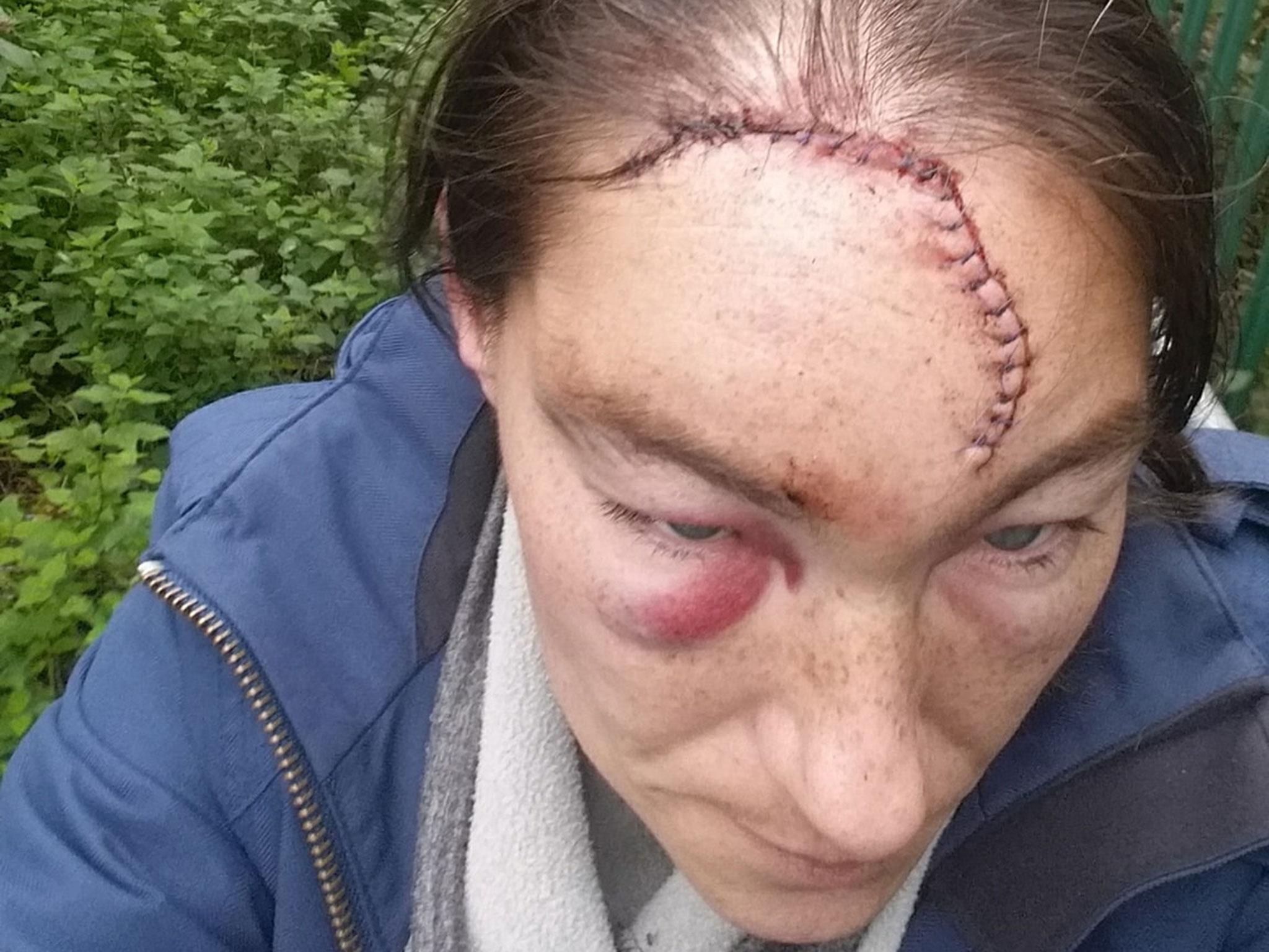 Nikki Hurst, 32, shared pictures of her injuries from the attack on Facebook