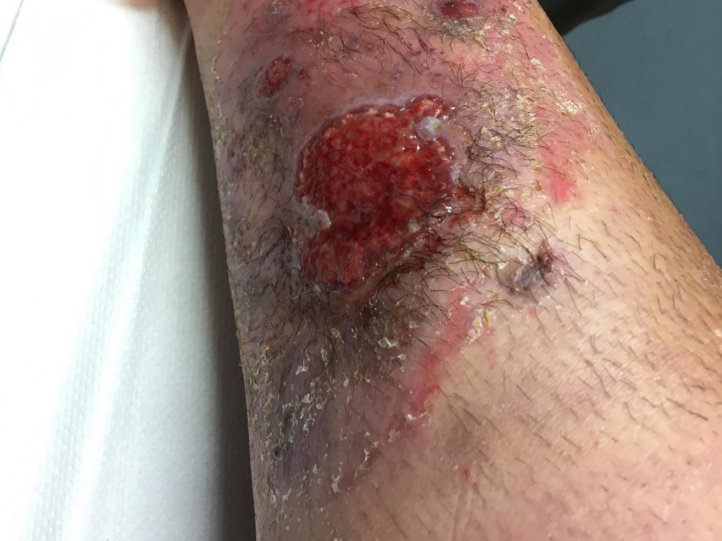 Mysterious spider bite leaves woman unable to walk and still