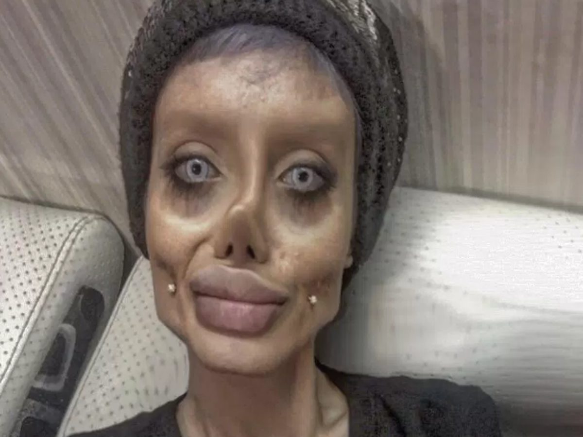 Teen behind viral 'Angelina Jolie' plastic surgery photos reveals