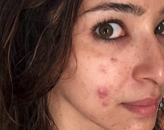 A doctor shared a photo of her adult acne for an important reason