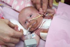 Girl born with heart outside her body survives surgery in UK first
