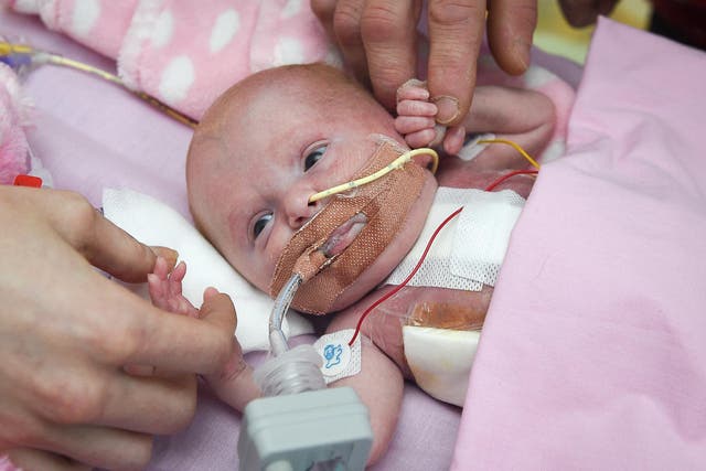 Vanellope, at three weeks old, has had three surgeries and is now on a ventilator while she recovers
