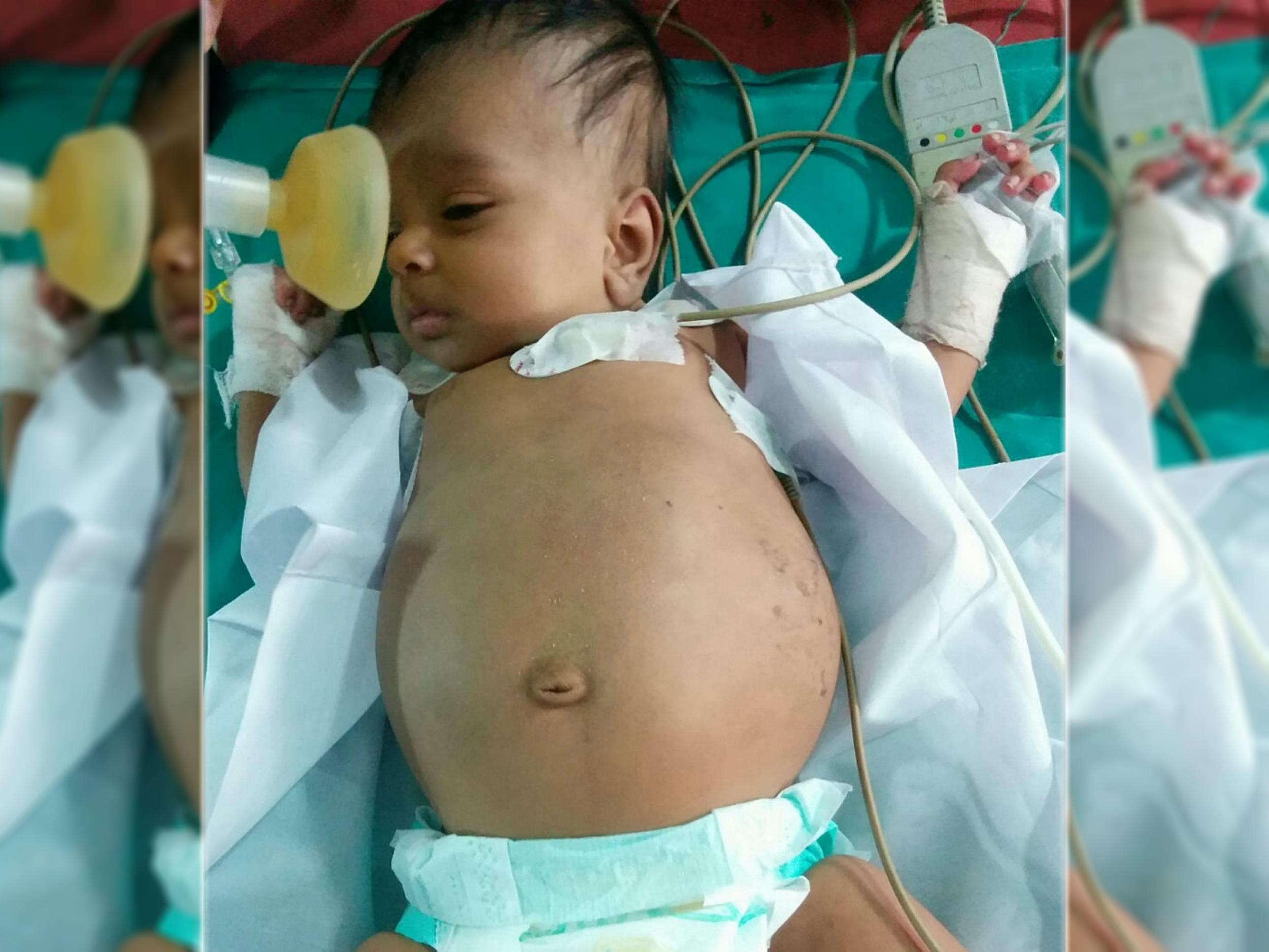 Parents of a three-month-old baby previously diagnosed with "a kidney tumour" were shocked when the doctors told them that there was a foetus of the toddler's twin inside his stomach