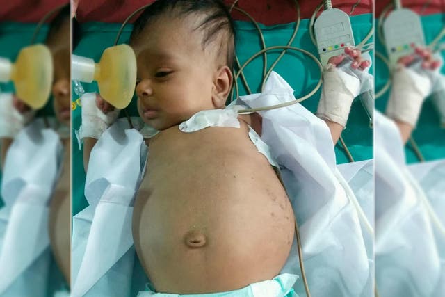 Parents of a three-month-old baby previously diagnosed with "a kidney tumour" were shocked when the doctors told them that there was a foetus of the toddler's twin inside his stomach