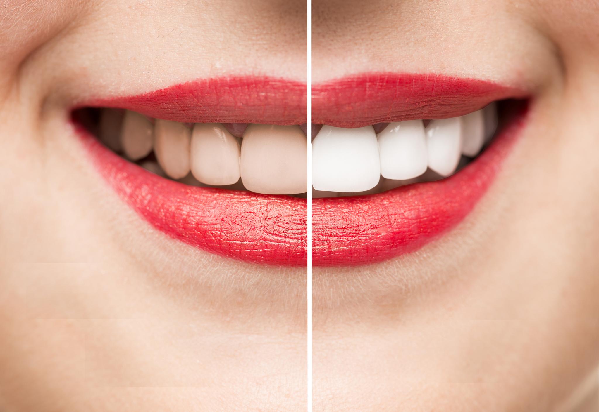 How to get whiter teeth Four top tips to help achieve a