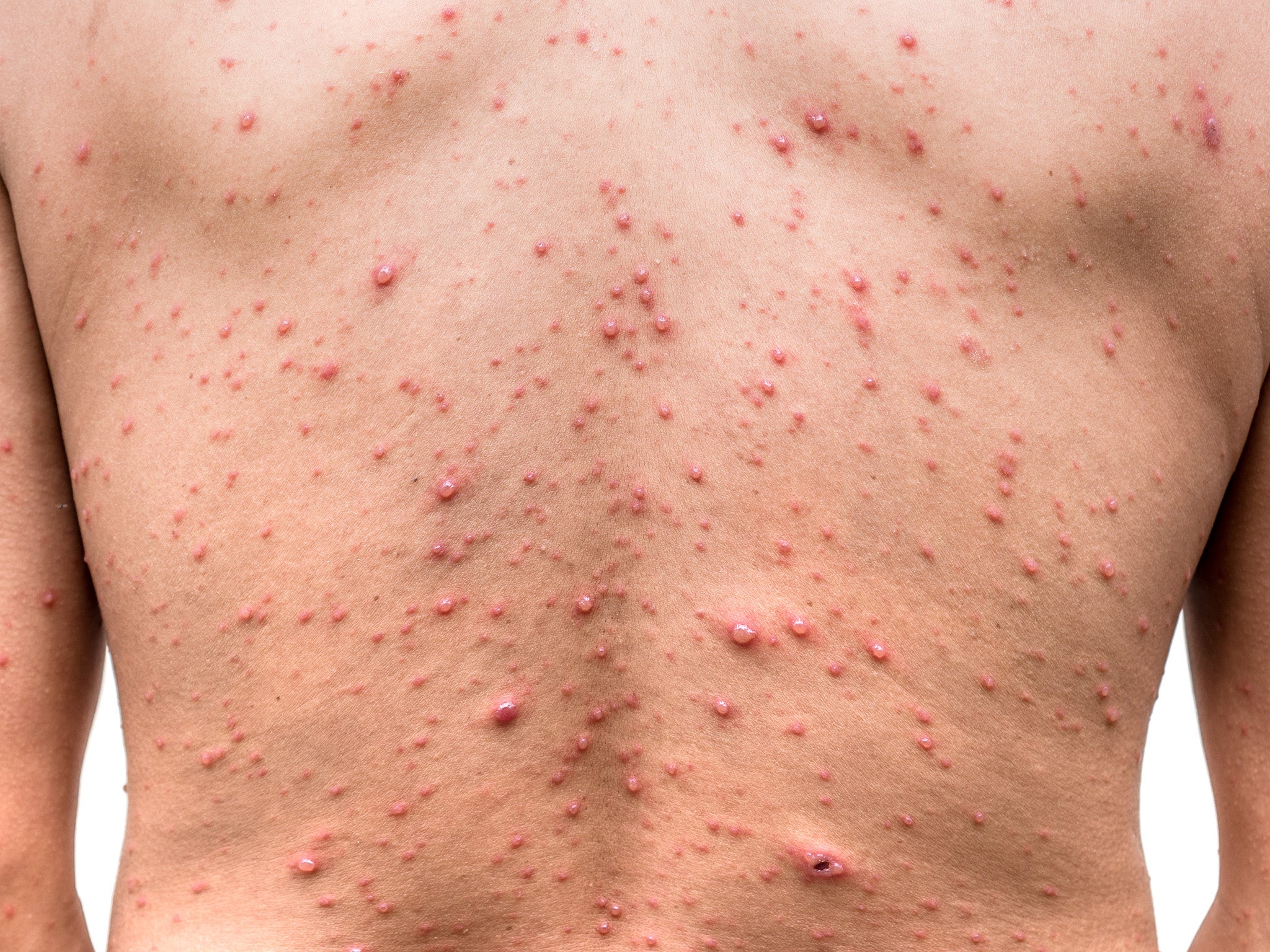 Chickenpox can have serious complications including stroke and pneumonia