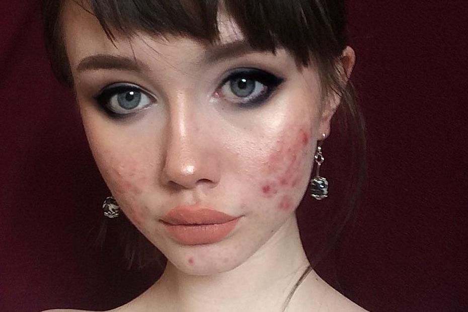 Teen Proudly Shows Off Her Acne With Foundation Free Selfies The