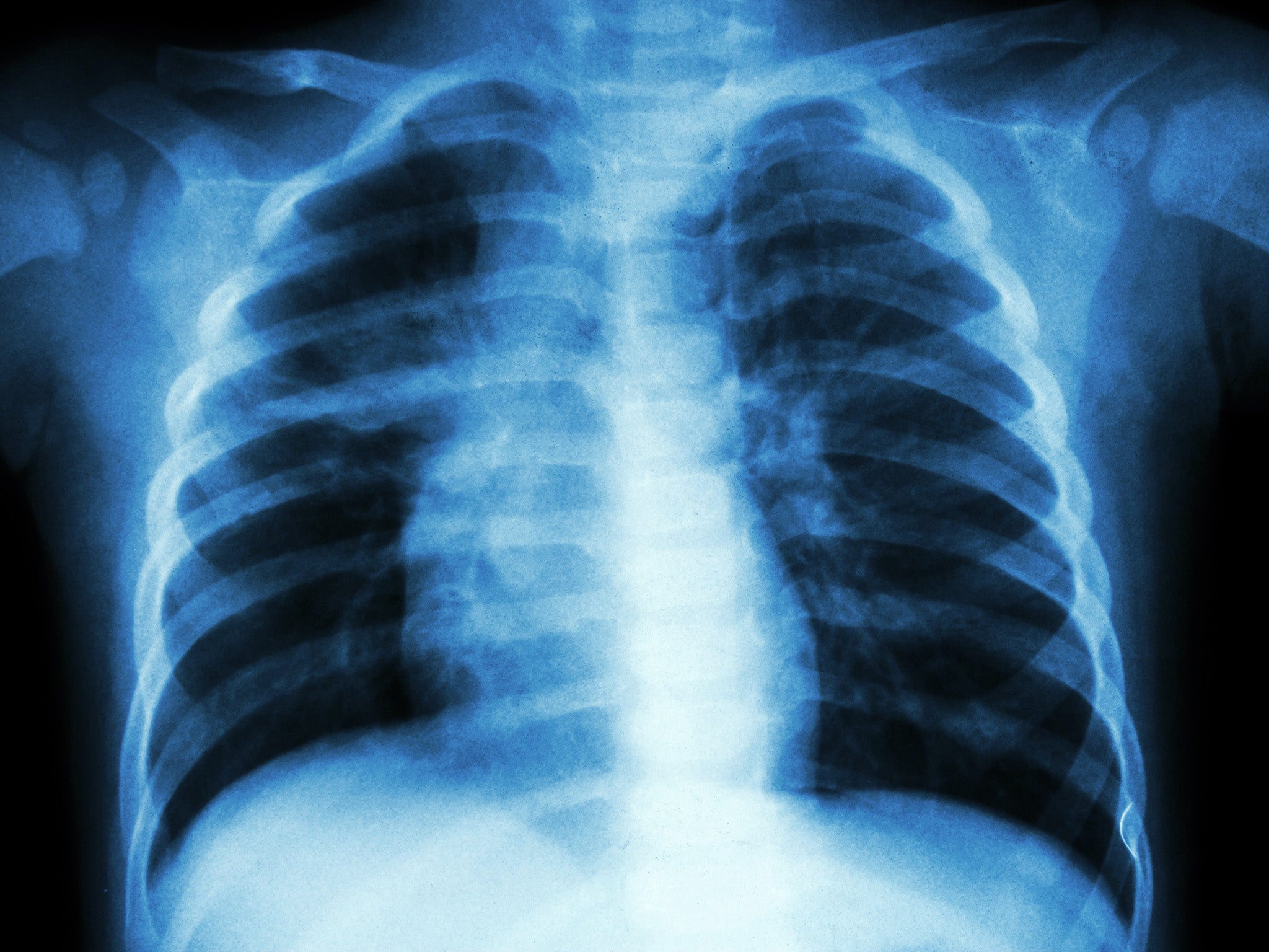 X-ray of an infected lung with tuberculosis