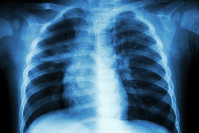 For decades, the bacterial infection has been confirmed by X-rays, which only detects advanced damage
