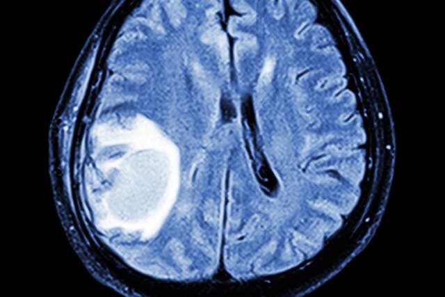 A tumour seen on an MRI scan. The treatment was able to stimulate an immune response even in cancers found deep within the brain