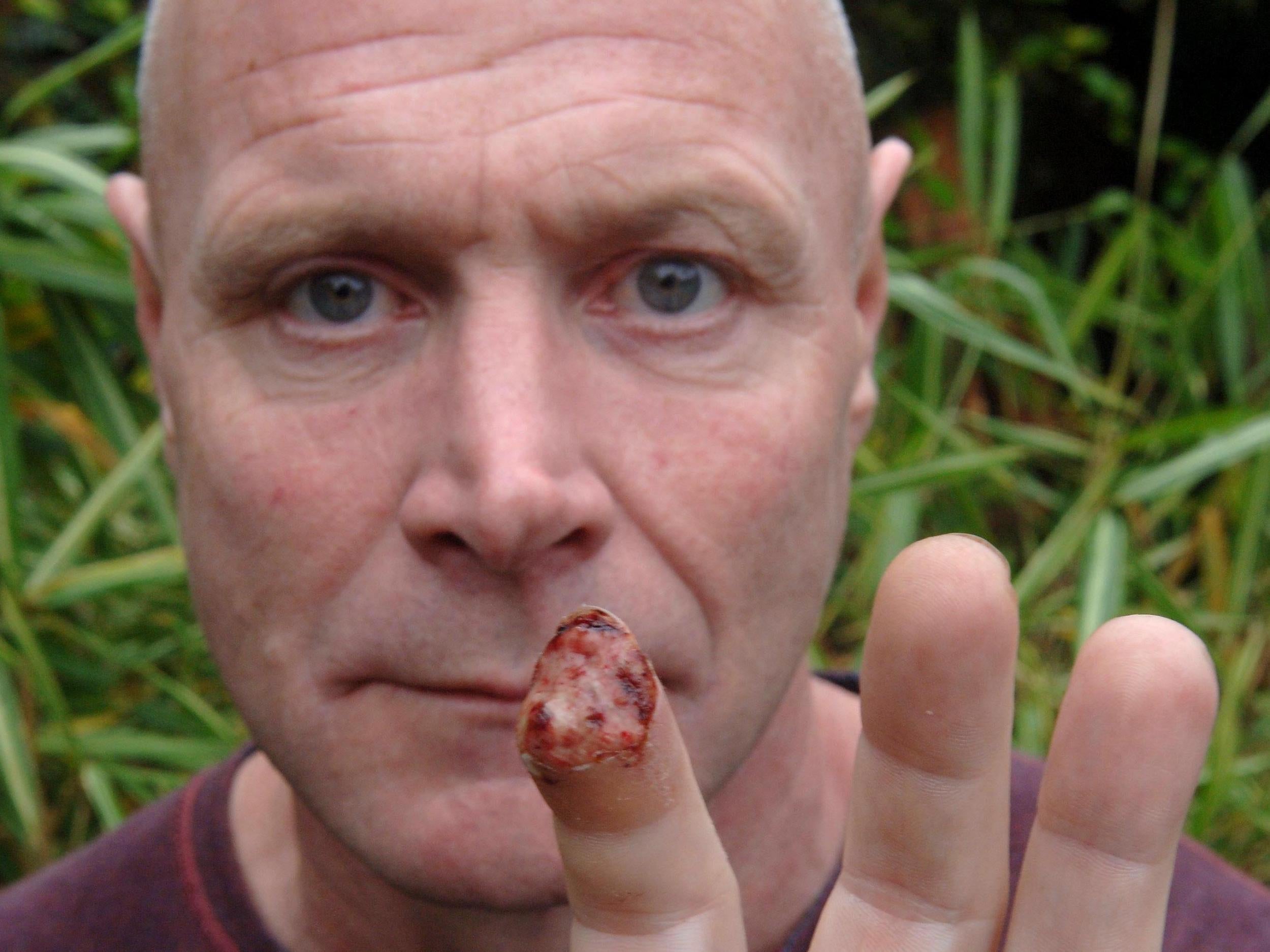 Clive Lilley shows where he lost the tip of his finger after being attacked by a wild boar