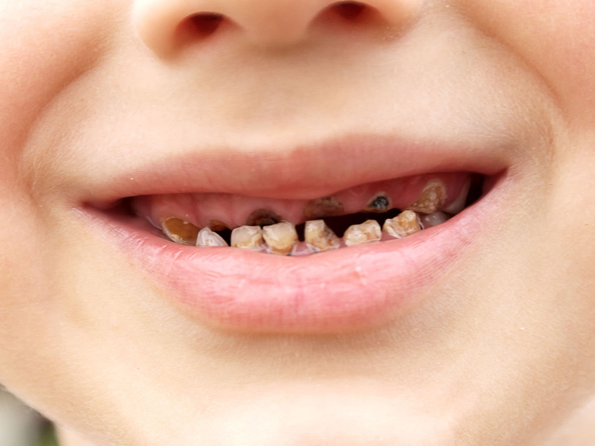 Soaring rates of tooth extractions and obesity in children have been linked to sugar