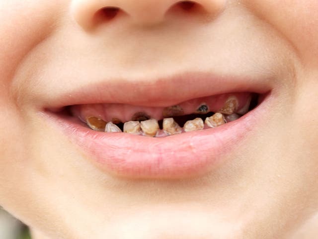 Rotten tooth removal is single biggest cause of children being admitted to hospital in UK