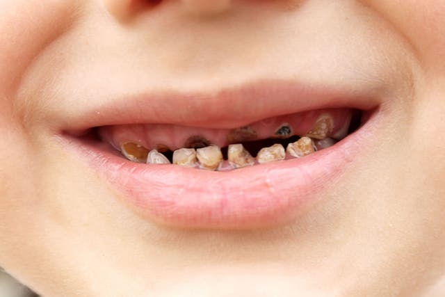 Soaring rates of tooth extractions and obesity in children have been linked to sugar