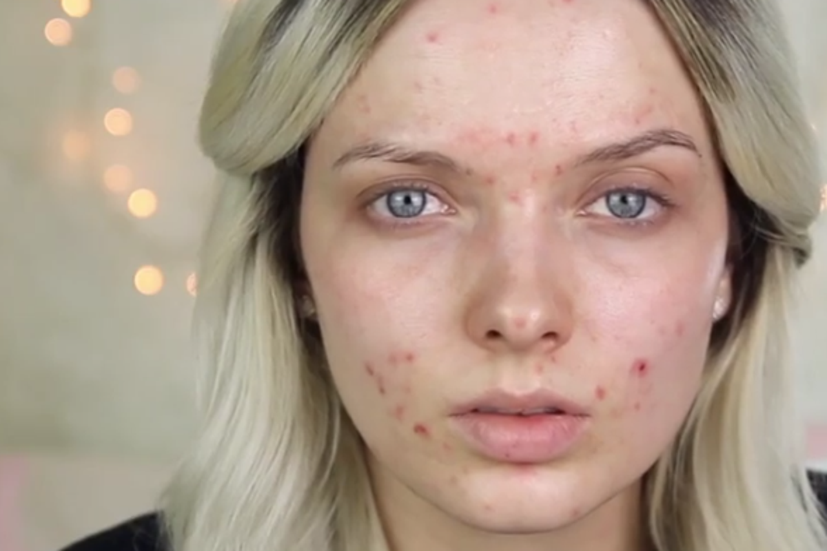 Women Are Posting Makeup Free Selfies To Spread Acne Positivity The Independent The Independent 4906