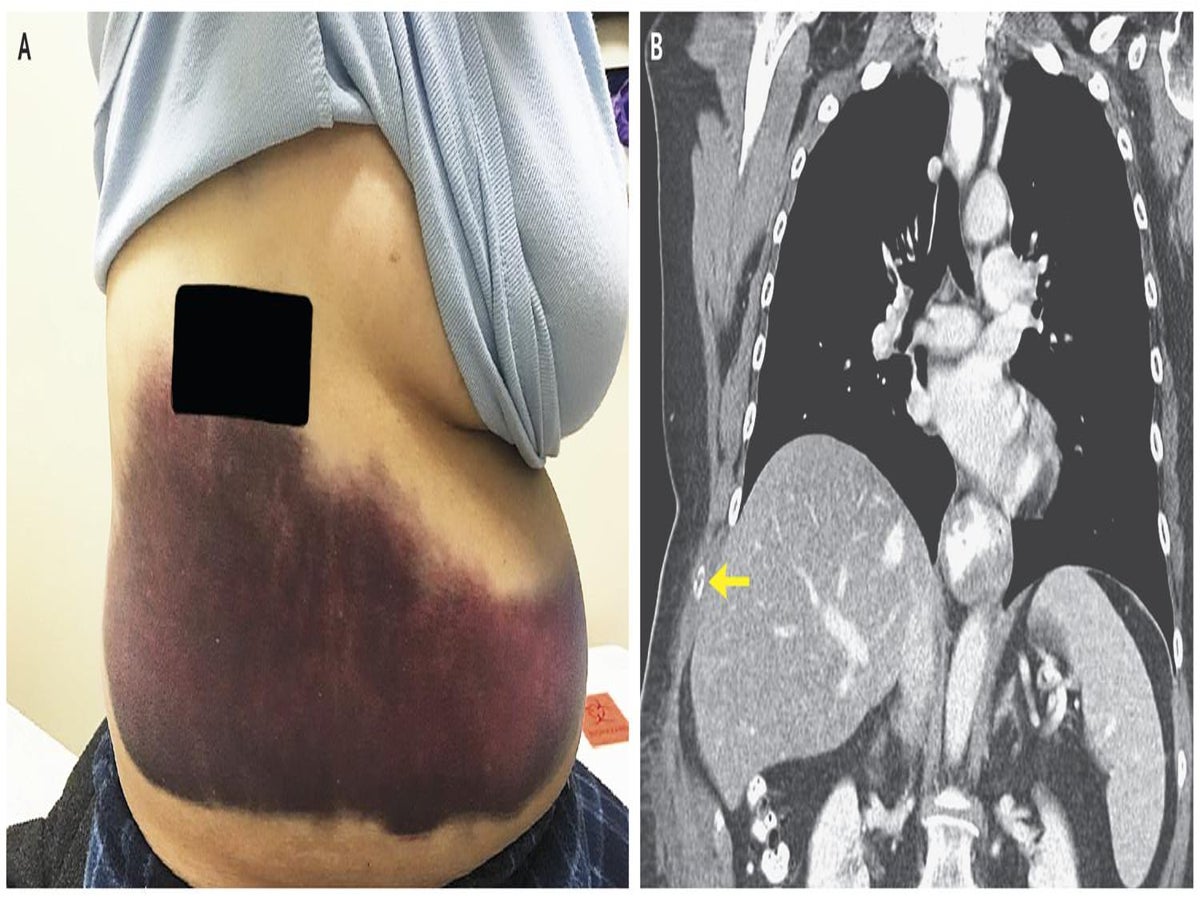 Bruised Ribs From Coughing
