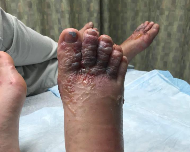 The couple's feet swelled up with boils