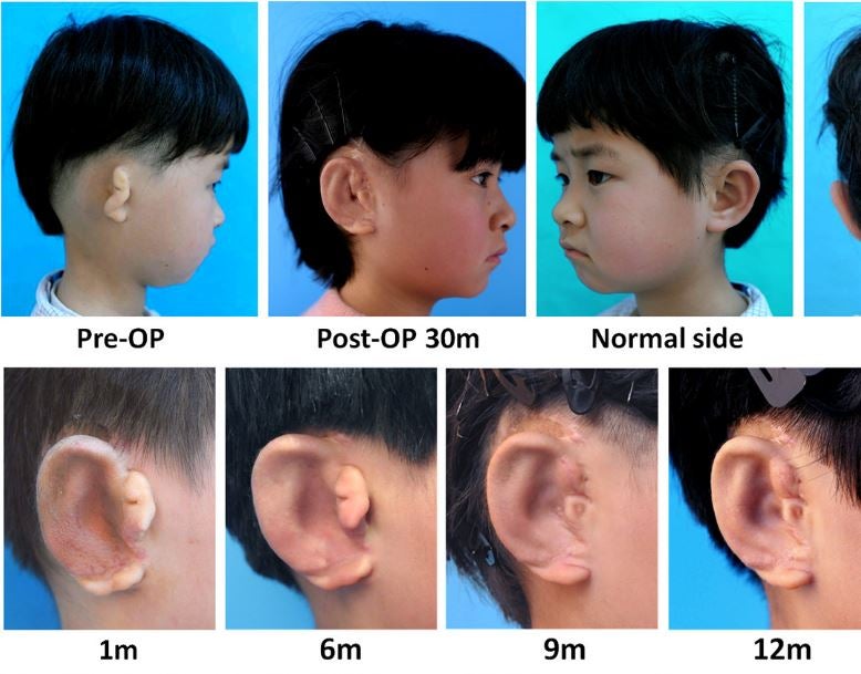 Children receive new ears grown from their own cells in world