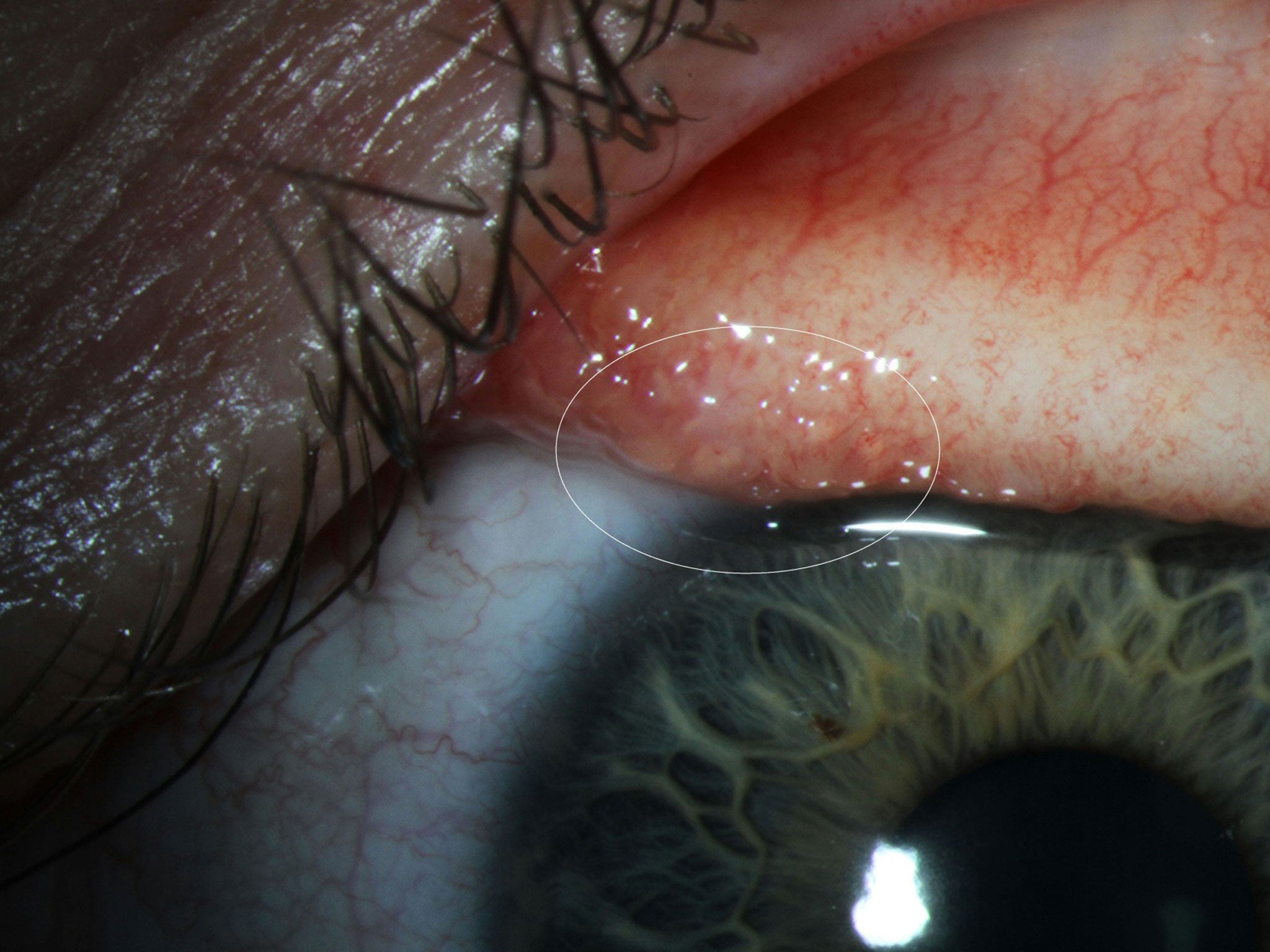 An image released by the CDC shows Ms Beckley's infected eye. The flies feed on the tears that lubricate the eyeball, scientists said