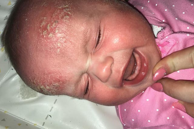 Joanne Nevin first noticed patches of eczema on Kelisha's skin when she was three months old