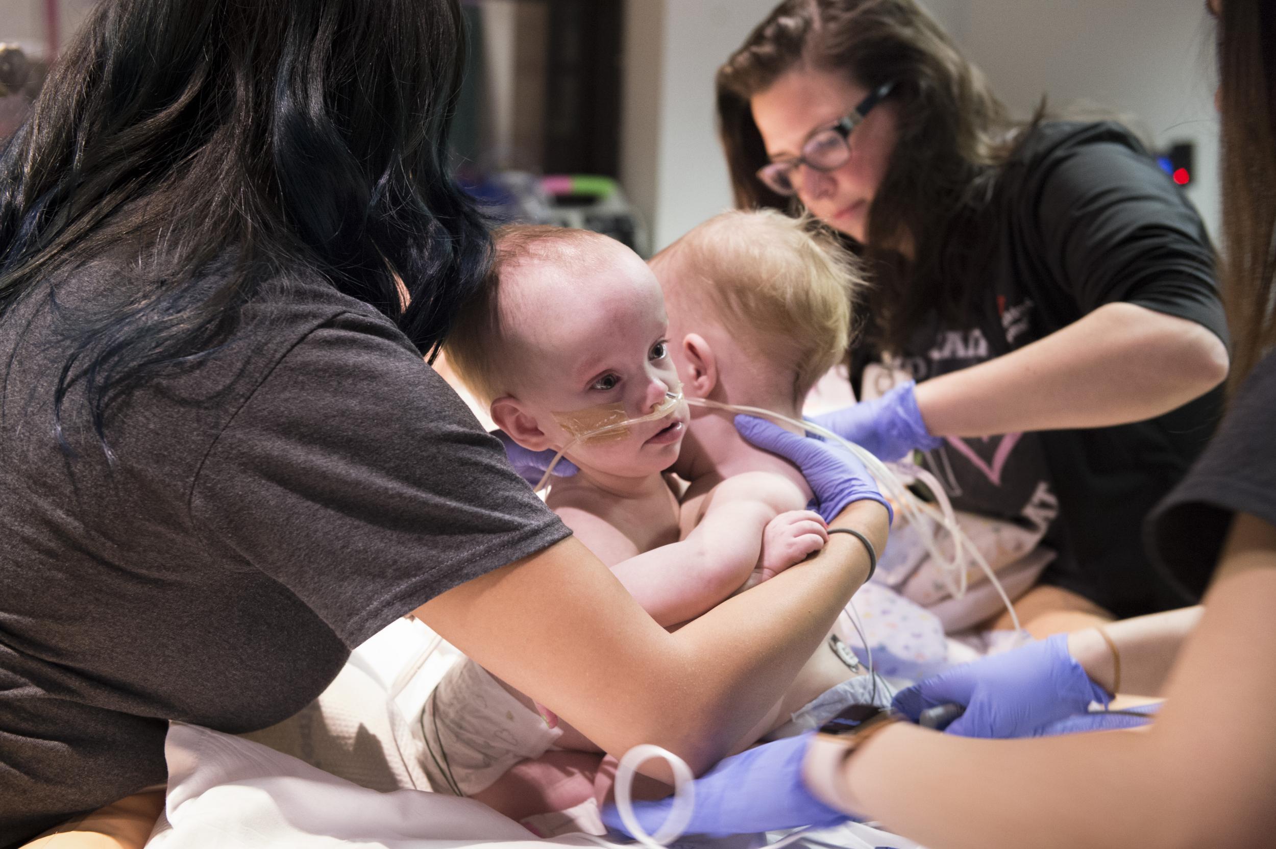 Anna and Hope before their surgery (Paul Vincent Kuntz/Texas Children's Hospital)