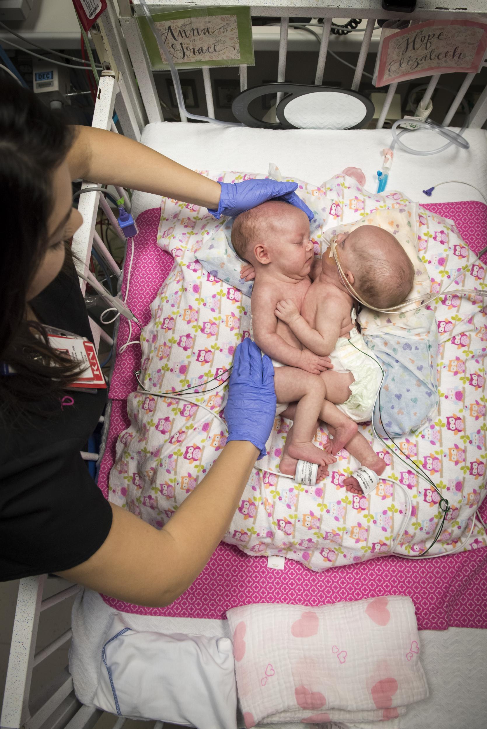 Anna and Hope spent their entire lives in the NICU (Paul Vincent Kuntz/Texas Children's Hospital)