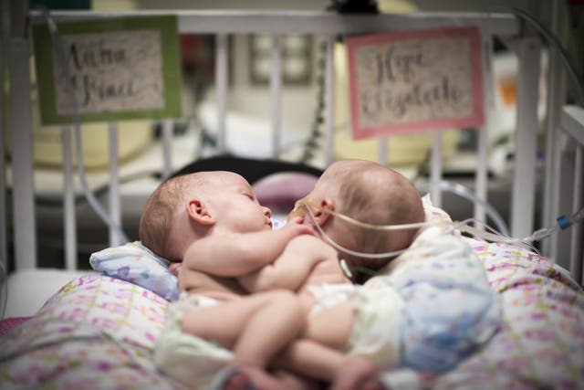Conjoined twins Anna and Hope Richards before their life-changing surgery
