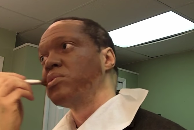 Fox TV reporter Lee Thomas covers his vitiligo 