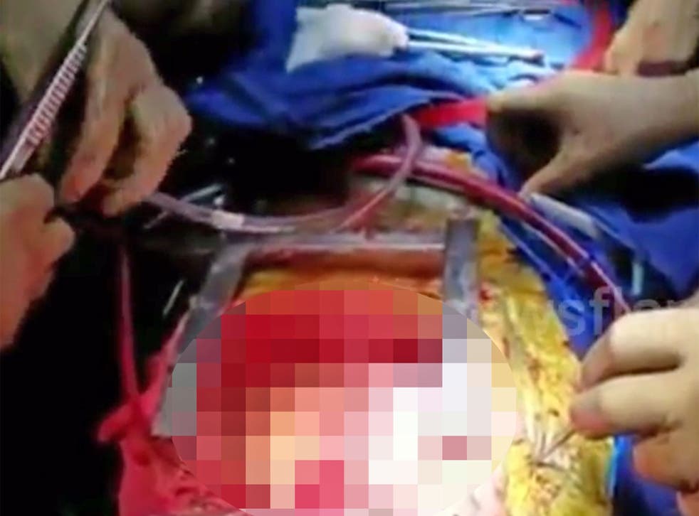 Surgeons inserted the donor's heart alongside the patient's existing one