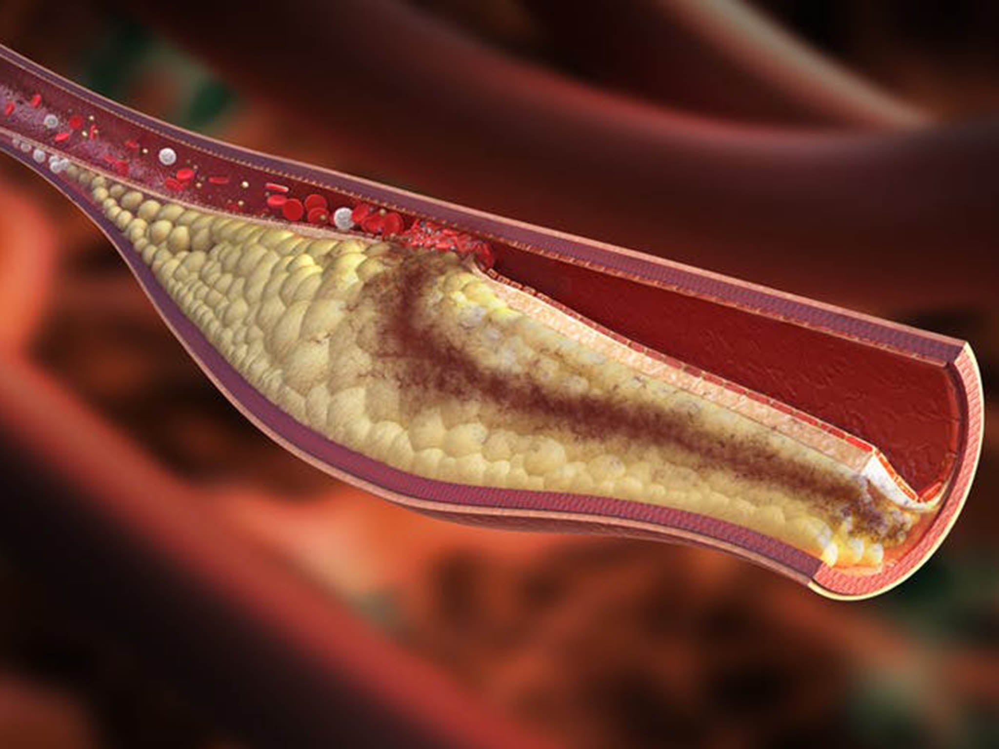 Heart attacks are caused by the build-up of atherosclerotic plaques in the arteries of the heart