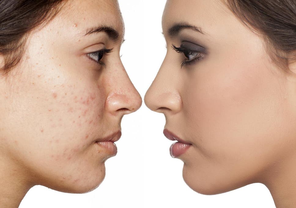 what acne does sulfur help