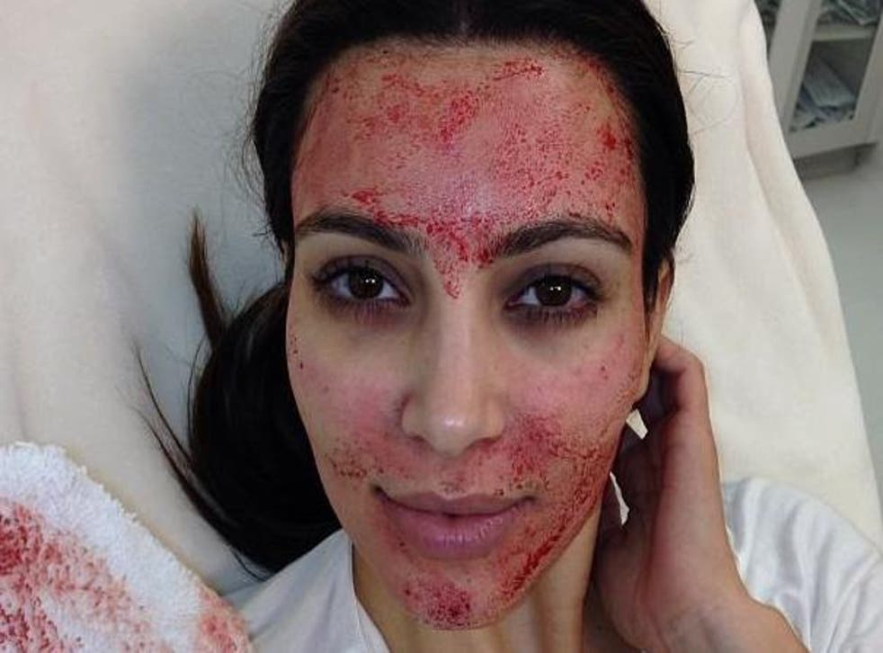 The aftermath of Kim Kardashian's infamous vampire facial (Pic: Instagram/Kim Kardashian)