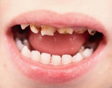 Parents who kiss kids on lips before teeth develop may spread bacteria