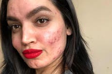 Beauty blogger with acne dropped from L’Oréal campaign