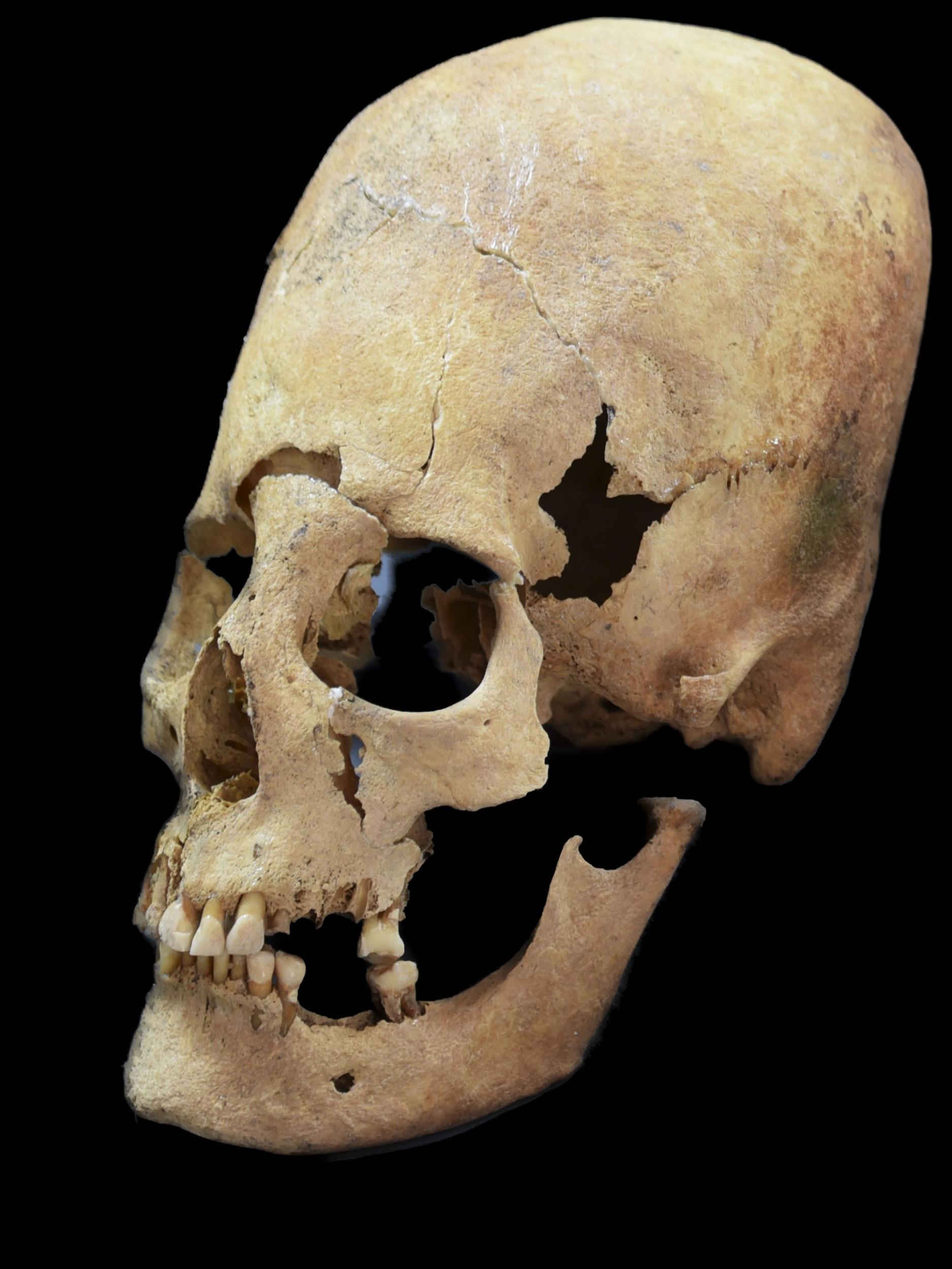 Artificially deformed female skull from Altenerding, an Earyl Medieavel site in Bavaria