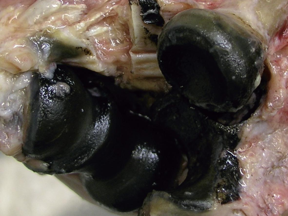 Cartilage in the elbow and other joints is blackened and made brittle over time leading to osteoarthritis