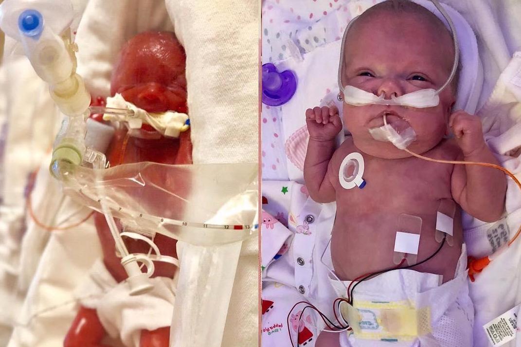 Premature Baby