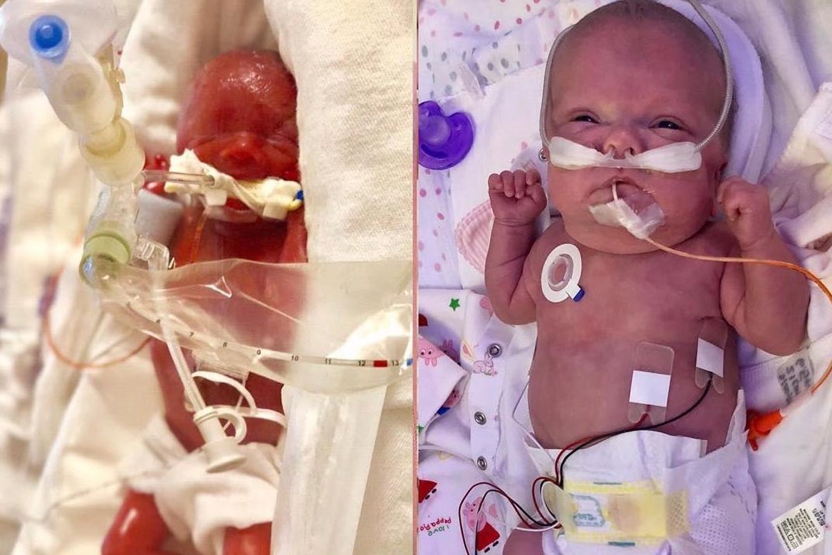 Photos Show Incredible Transformation Of Premature Baby Born At 23 Weeks The Independent The Independent