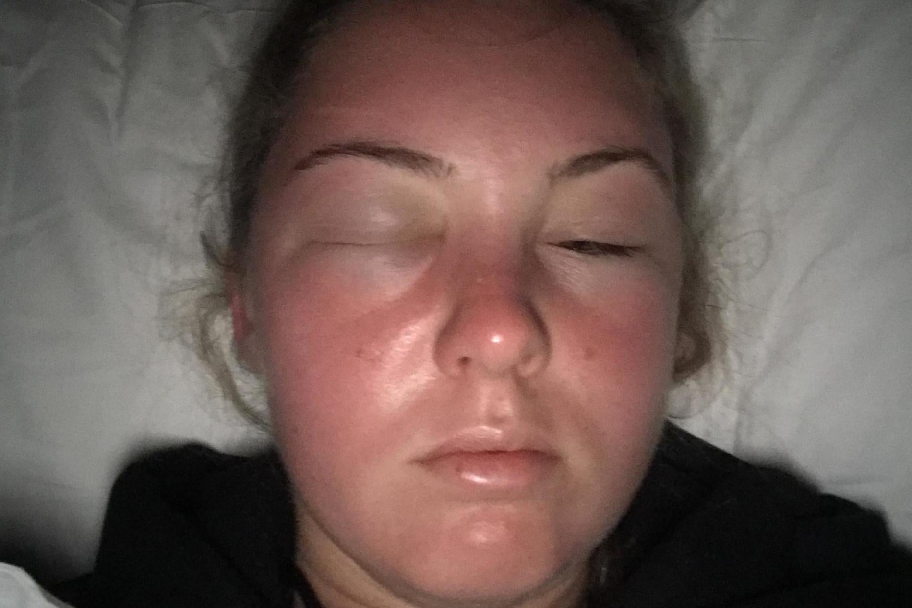 Holly Barrington's face swelled uncontrollably overnight after a day in the sun in Tenerife