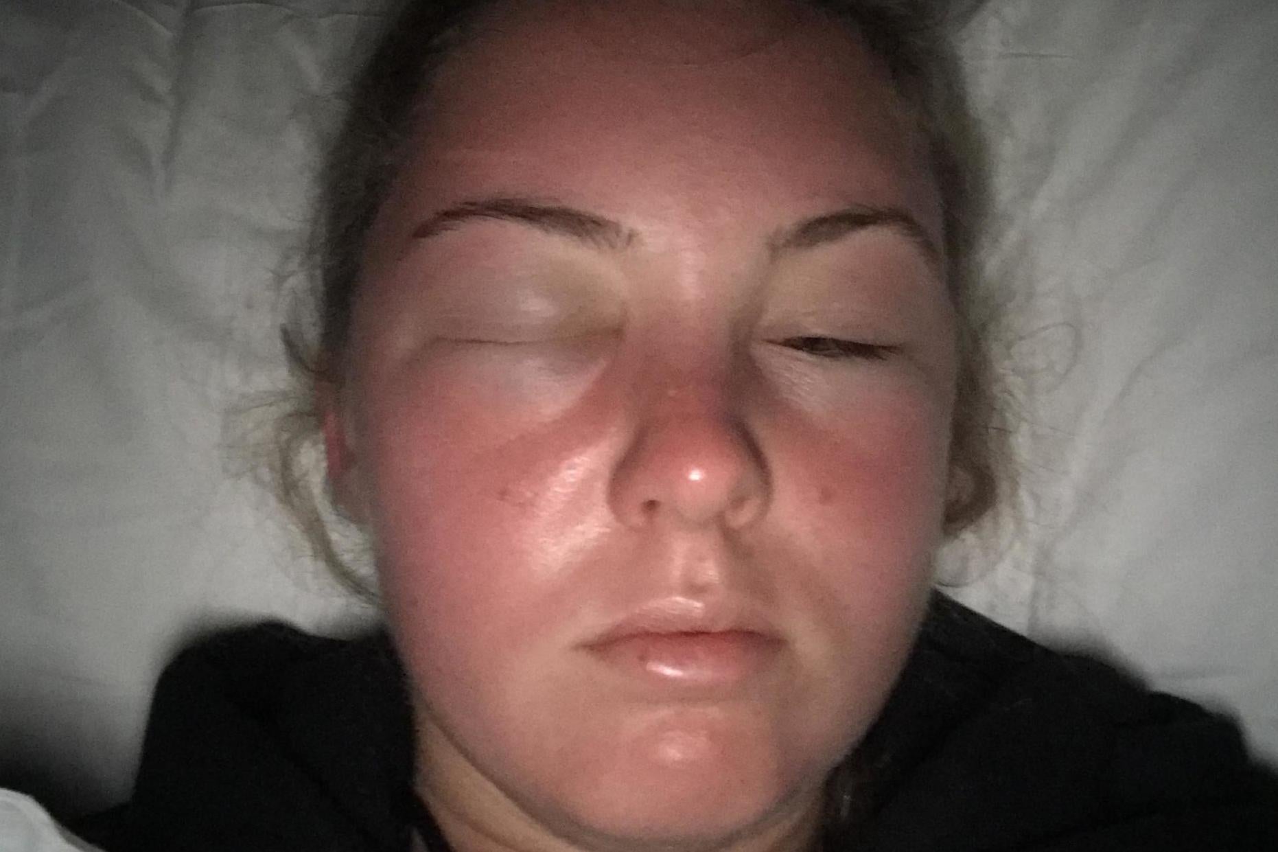 sunscreen in eyes swollen