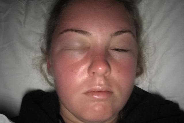Holly Barrington's face swelled uncontrollably overnight after a day in the sun in Tenerife